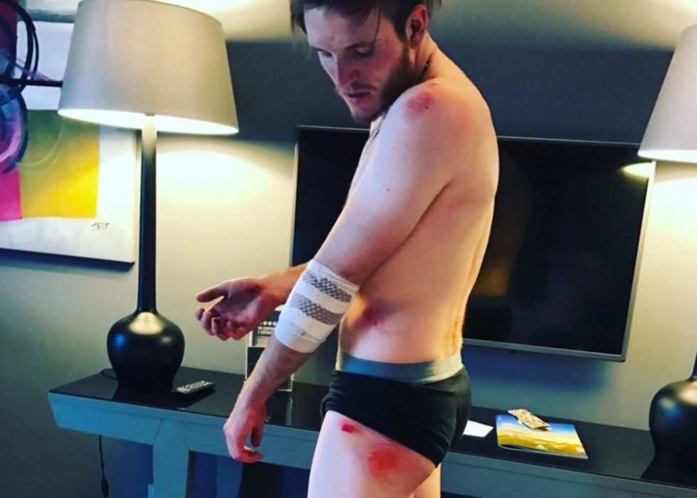 VONDT: Syklist Petter Theodorsen pådro seg en del sår og skraper etter at forhjulet hans ble klippet ned av en konkurrent under etapperitt i Portugal nylig: - Dusjing? Jeg har forsøkt å glemme det litt. Det gjør så vondt