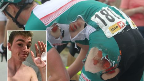 AU DA! procycling.nos bilder fra Ringerike Grand Prix viser tydelig hvor hard medfart Idar Andersen fikk under velten. I det nederste bildet viser 18-åringen fram såret i hånda