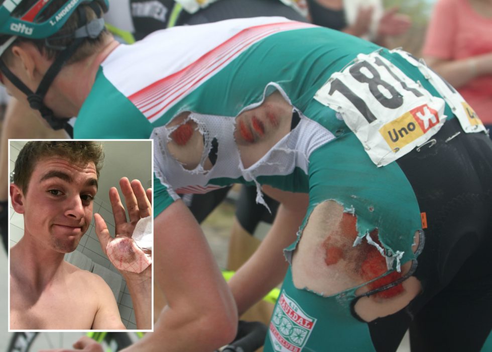 AU DA! procycling.nos bilder fra Ringerike Grand Prix viser tydelig hvor hard medfart Idar Andersen fikk under velten. I det nederste bildet viser 18-åringen fram såret i hånda